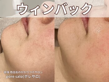 ポレ サロ(pore salo)/【ウィンバック｜たるみケア】
