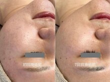 ヒュウ(hue.)/韓国発最新肌管理[セルマン]