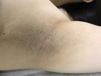 ナノハナ/鹿沼市本格脱毛の美容室ナノハナ