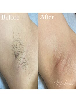 マベル シュガーリング(Mabelle)/脇のW脱毛