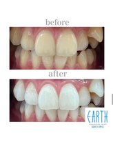 アース 福岡天神店(EARTH)/before　after　【美白】