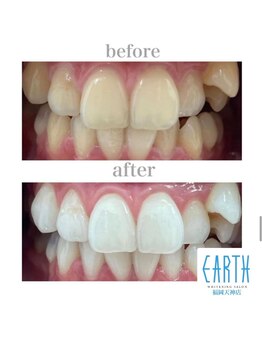 アース 福岡天神店(EARTH)/before　after　【美白】