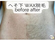 ビビユー(bibi u)/へそ下《WAX脱毛》beforeafter