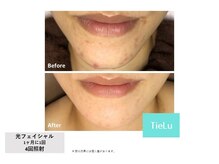 ティエル(TieLu)/光フェイシャル