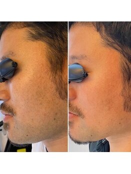 レイ(Rei)/男性の毛にもしっかり効果！