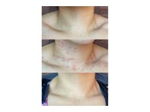 ヴィアス(Vias)/シミケアコース