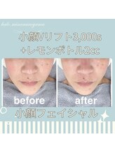 ハロ 南青山(HALO)/小顔Vリフト+レモンボトル