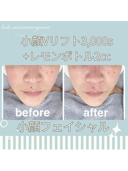 ハロ 南青山(HALO)/小顔Vリフト+レモンボトル