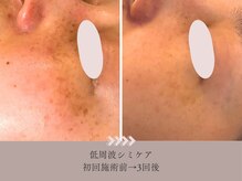 頬を覆っていた赤みと長年蓄積したシミも3回のケアでここまで◎