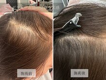 ル キヤ アイスペシャリテ ハービスENT店/【ビフォーアフター】育毛促進