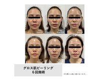 モイ(Moi’e)/シワ・たるみ・くすみ・ツヤ肌