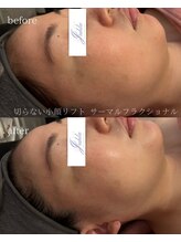 ユフラ(Juhla)/切らない小顔リフトサーマル
