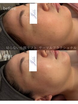 ユフラ(Juhla)/切らない小顔リフトサーマル