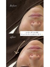 ライム 武蔵小杉(LIME)/レモンボトル｜小顔ケア