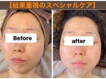 ルルン(LuLuN)/毛穴洗浄×美容液導入×造顔小顔