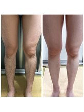 ダカイン(D'kine)/短パンが履けた！