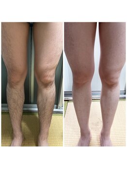 ダカイン(D'kine)/短パンが履けた！