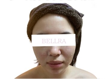 ベルラ(BELLRA)の写真/速攻小顔&最強小顔メニューが豊富！次世代マシン◇ウルトラリフト小顔★サーマルフラクショナルRF新登場♪