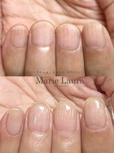 マリーロール 梅田店(Marie Laure)/自爪育成/深爪矯正/ネイルケア