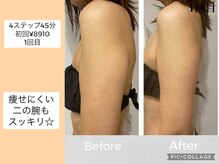 ハピネス(HAPPINESS)/4ステップメニュー　二の腕1回目