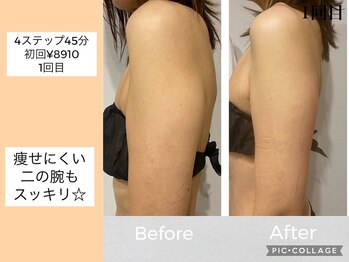 ハピネス(HAPPINESS)/4ステップメニュー　二の腕1回目