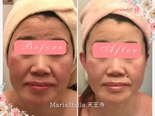 マリスステラ 天王寺(MarisStella)/ほうれい線,小顔に/天王寺エステ