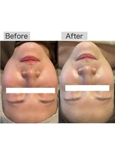 フイユ(feuille)/ILLUSTRIOUS 美白ピーリング