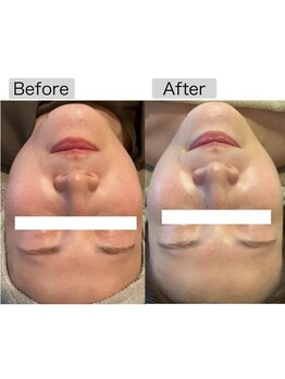 フイユ(feuille)/ILLUSTRIOUS 美白ピーリング