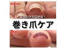 「深爪」　「巻き爪」の方もお気軽にご相談ください♪