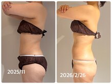 美活ラボ(美活LABO)/3ヶ月後