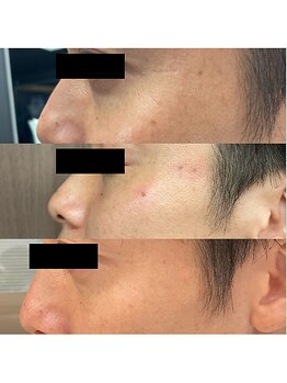 ビューティーラベンダー/プラズマビフォーアフター