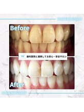 ホワイトニングショップ 太田店/ホワイトニングビフォアフター
