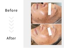 アブニールブリヨン/ハーブピーリング　Before After