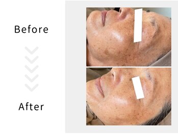 アブニールブリヨン/ハーブピーリング　Before After