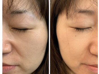 ブルーコーラル エム(BLUE CORAL M)/毛穴スッキリフェイシャル