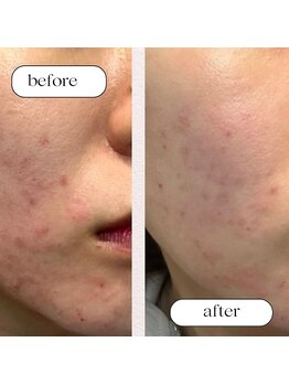 トータルビューティーサロンリア(Li'a)/ビフォー＆アフター