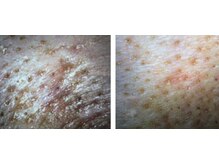 ディサイドロー(DECIDE L.A.W)/毛穴の変化！