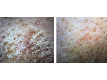 ディサイドロー(DECIDE L.A.W)/毛穴の変化！