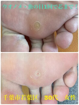 巻き爪じゅん 船橋店/ウオノメ１回で芯まで取れた！