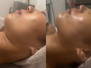 インディバサロン カルム(Calm.)の写真/【話題沸騰★小顔美顔レモンボトル導入◎】インディバと合わせてW脂肪分解！小顔の相乗効果で二重顎解消♪