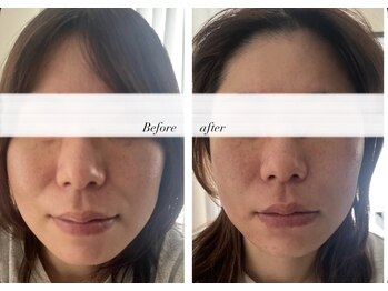 グラッソ(GRASSO)/マイクロウェーブ深層リフト