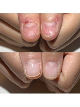 アティックネイルアトリエ(attic nail atelier)の写真/【深爪&美爪育成】圧倒的な技術力で、本来の美しさを取り戻す究極の自爪育成ケア★完全個室で相談しやすい