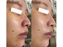 マスカレード 品川(Masquerade)/【症例写真】施術1回