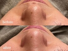 イリマレイサロン(iLima Lei SALON)/ハイドロ毛穴洗浄