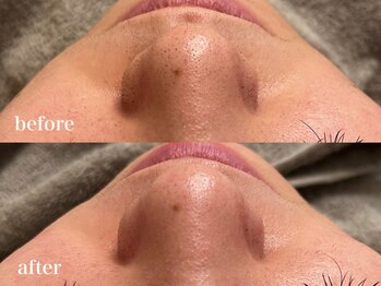 イリマレイサロン(iLima Lei SALON)/ハイドロ毛穴洗浄