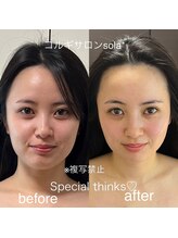 ソラ(sola*)/お客様コルギ施術before after