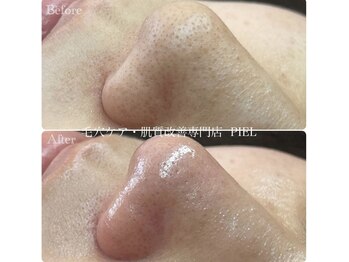 ピエル 北千住店(PIEL)/毛穴のお悩みはPIELにお任せ