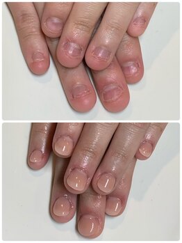 ティアラネイル(tiaranail)の写真/栃木県希少★根本改善を促す本格深爪矯正で長年悩む深爪も施術後に実感◎【本格深爪矯正/自爪育成】