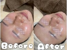 グラシア 倉敷店(Gracia)/毛穴洗浄＋ハーブピーリング