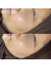 ルルラ リコ(lulula rico)/症例写真/ハーブピーリング